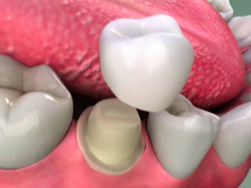 răng tạm được phủ lên cùi răng sau khi mài của bệnh nhân